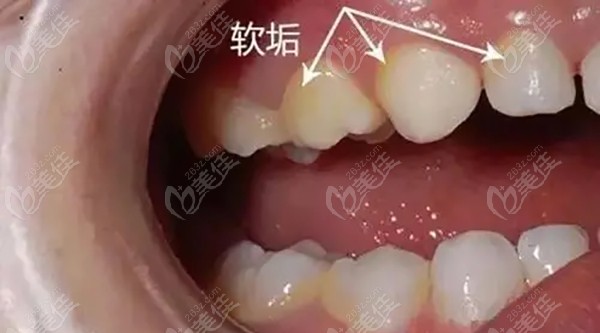 宝宝蛀牙早期症状图片
