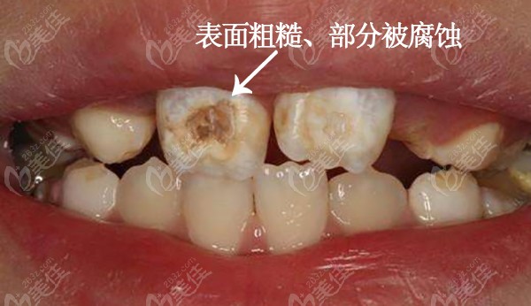 宝宝蛀牙早期症状表面粗糙