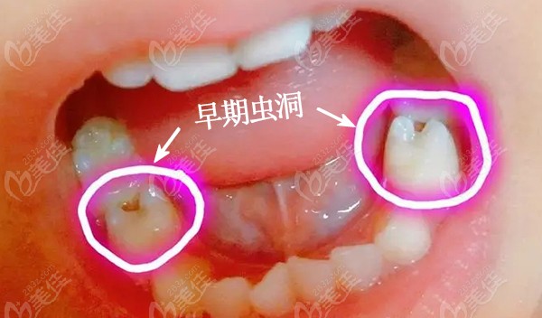 宝宝蛀牙早期症状图片虫洞、虫牙